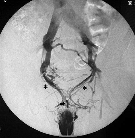 Venous leak .